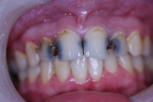 Composite Filling Before
