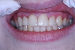 Composite Filling After