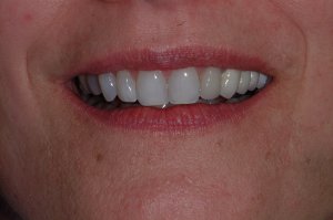 Smile with white teeth and a dental implant